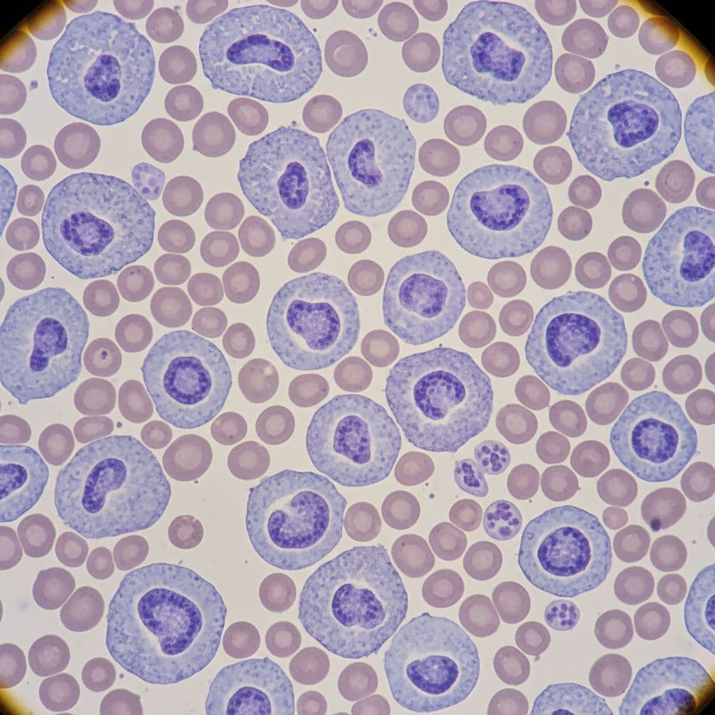 Enlarged abnormal B-lymphocytes of CLL crowd normal red blood cells and white cells in microscopic view with purple staining.