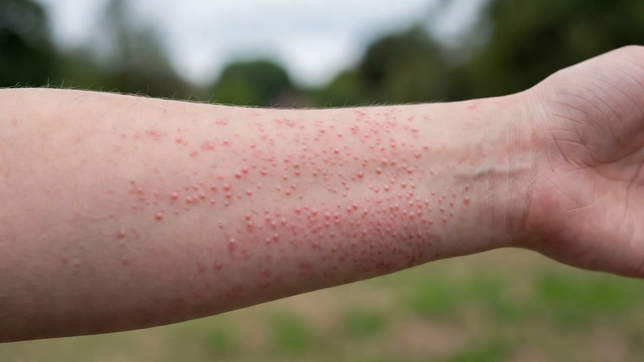 Sonallergie of hitteuitslag? So sien jy die verskil Natuurlike Medisyne Hierdie nabyskoot van 'n menslike onderarm vertoon rooi bultjies en gelokaliseerde rooiheid op die vel. Die saggefokusde beeld help om die kenmerkende velreaksies van sonallergie en hitte-uitslag duidelik te onderskei vir identifikasie.