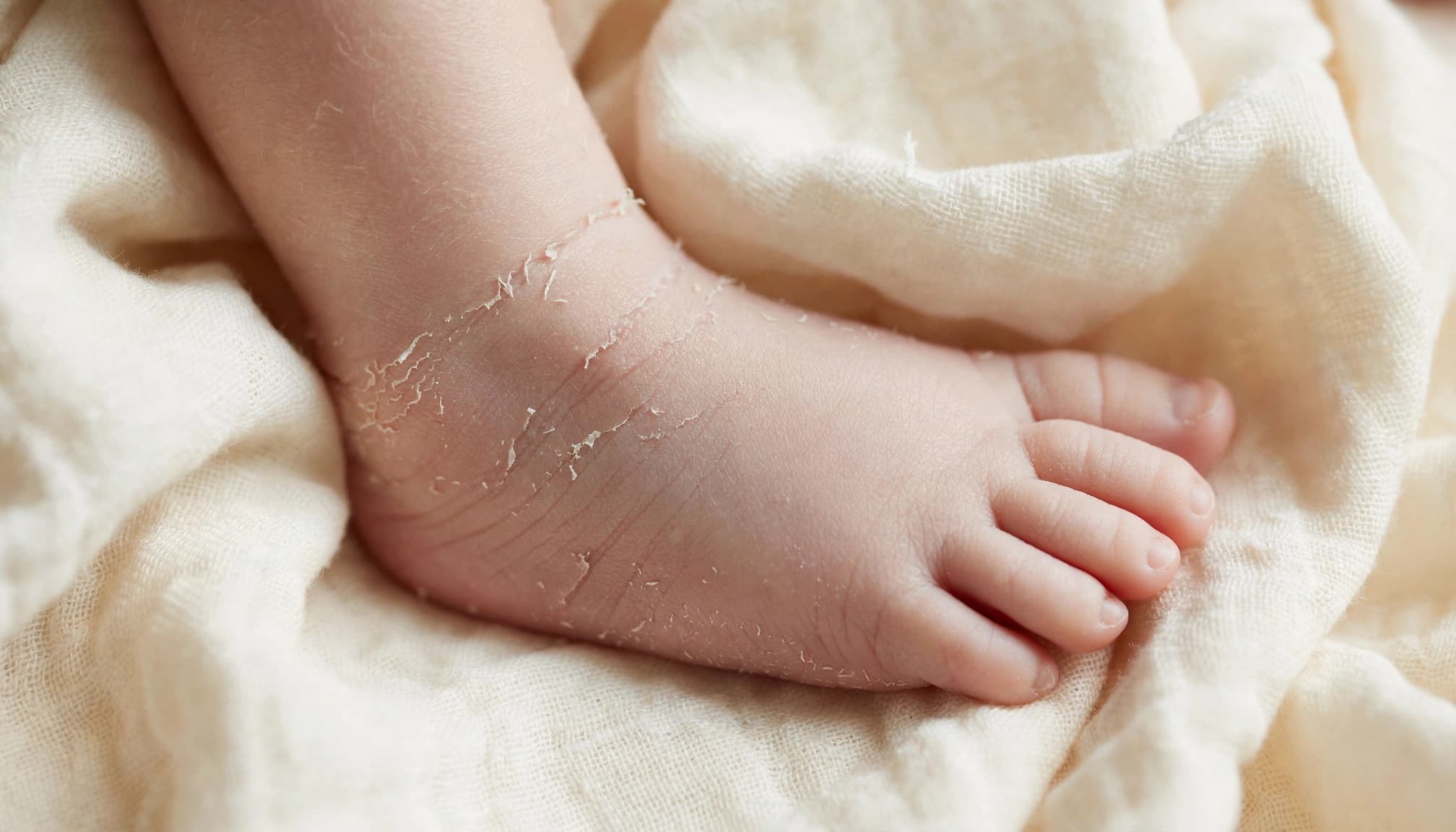 Newborn foot with mild peeling skin resting on a cream blanket.