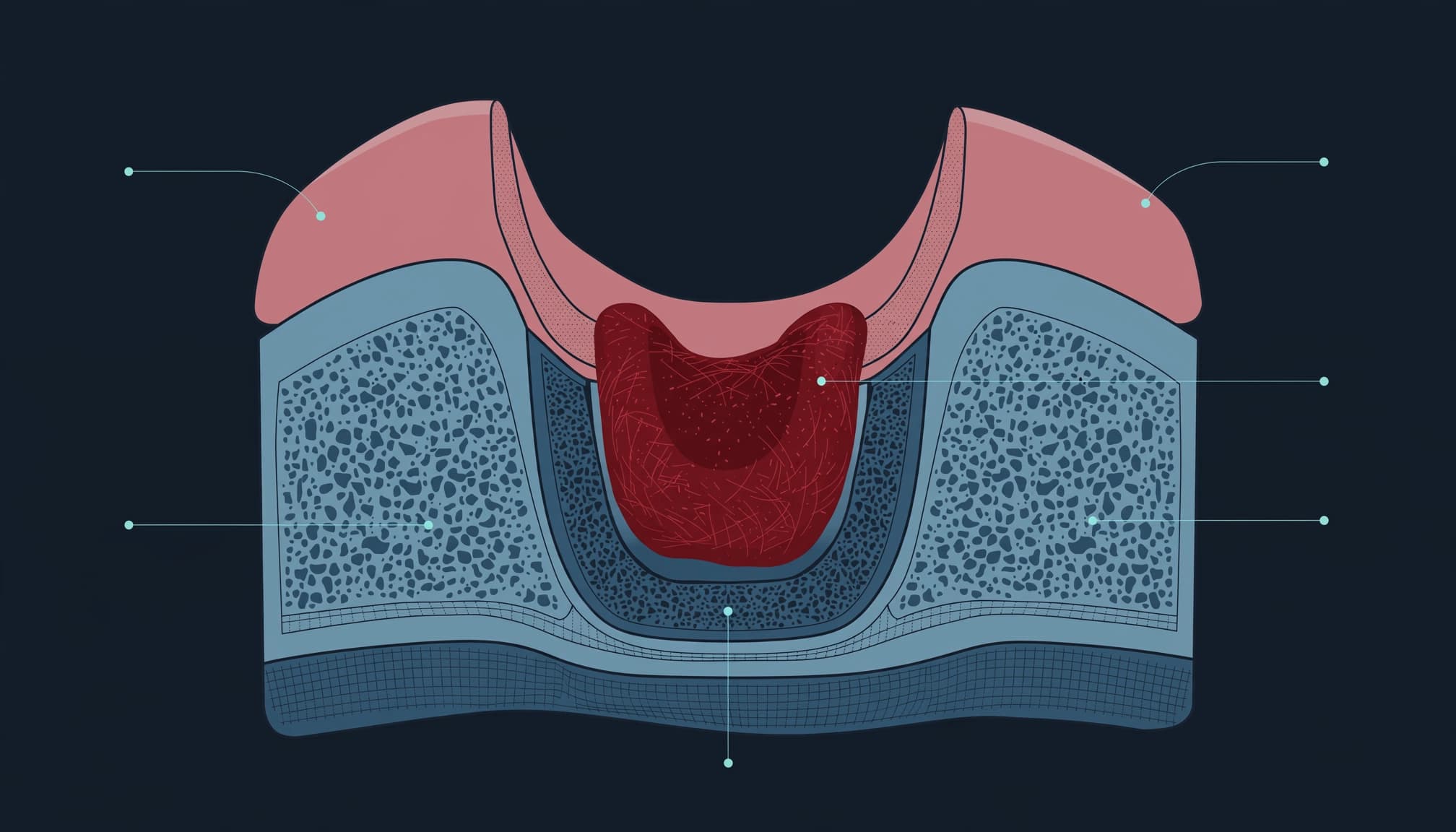 Illustration of a healing wisdom tooth socket with an intact blood clot.